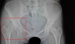 髋关节吃六瓜,髋关节健康之道